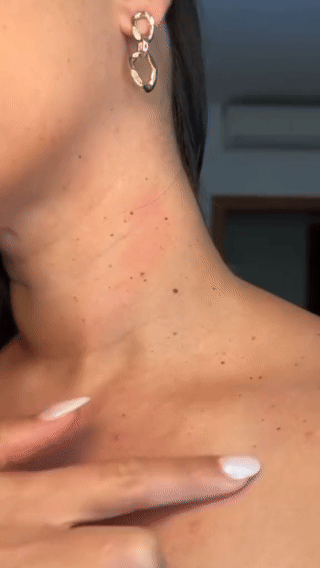 Elimina verrugas Tag recede PREMIUM ⭐⭐⭐⭐⭐